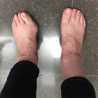 Pie plano valgo adulto y Hallux Valgus – resultado clínico ARCO