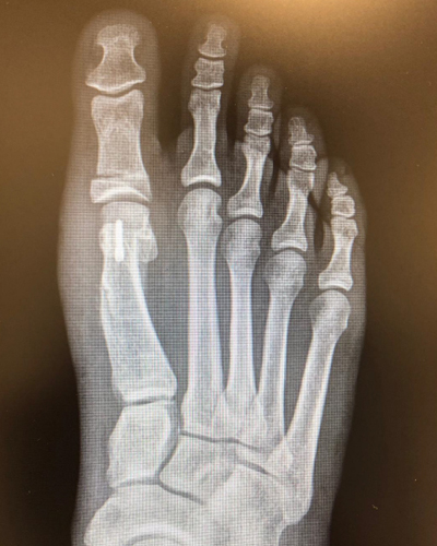Deformidad de Hallux Valgus – resultado clínico ARCO