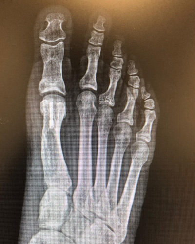 Deformidad de Hallux Valgus – resultado clínico ARCO
