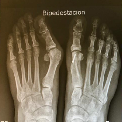 Cirugía de Hallux Valgus – resultado clínico ARCO