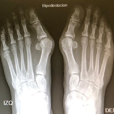 Cirugía de Hallux Valgus – resultado clínico ARCO